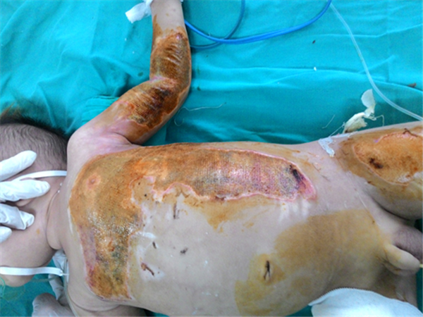 Cảnh báo: tự điều trị bỏng cho trẻ tại nhà - nguy hiểm khôn lường